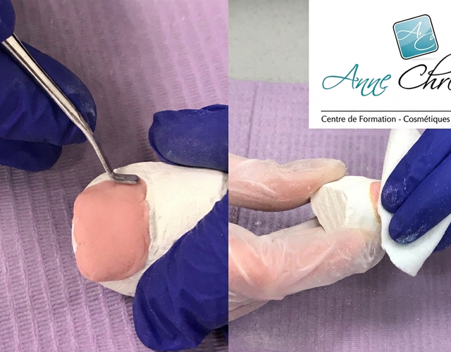 Onychoplastie (Reconstruction d'ongles)